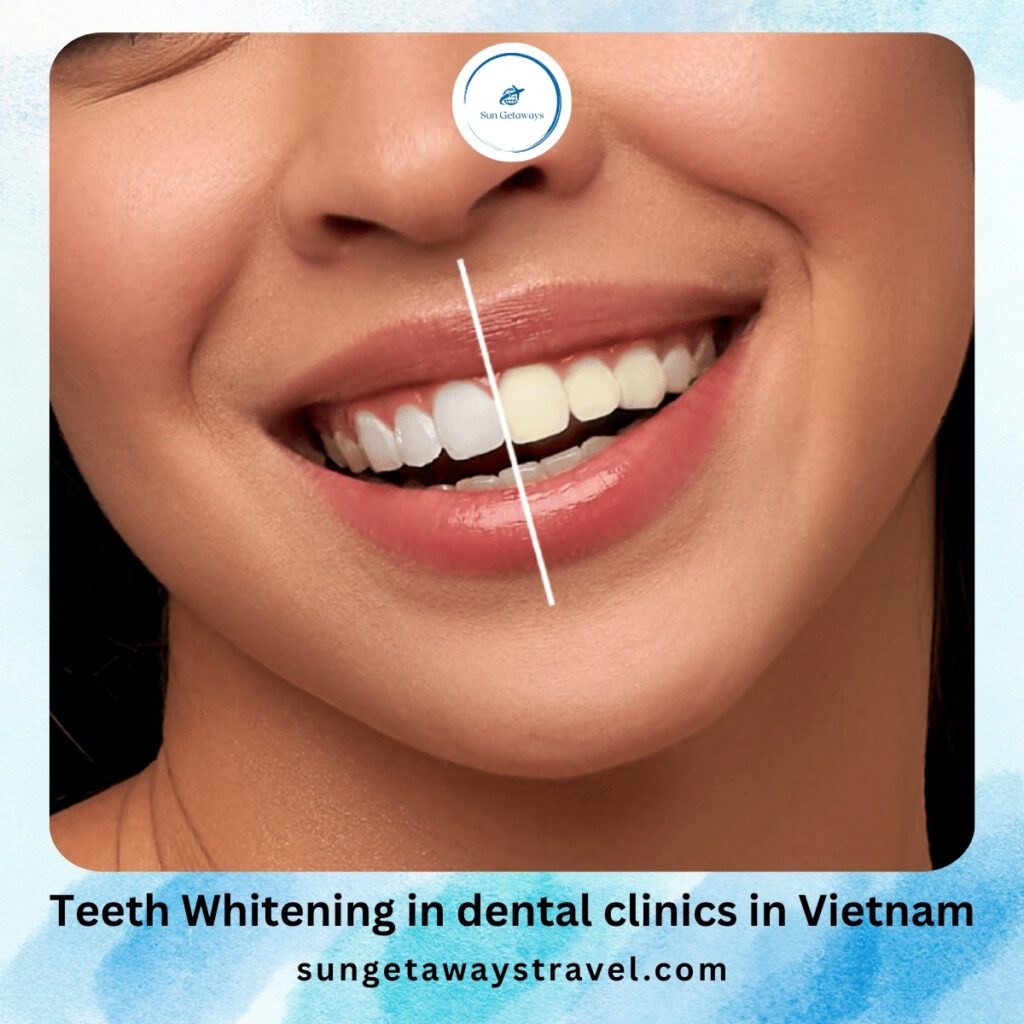 Teeth Whitening in dental clinics in Vietnam
