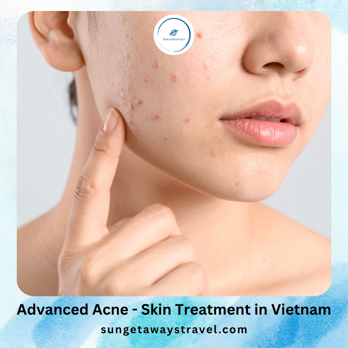 Effective Acne Coverage Getaways Of Skin photo